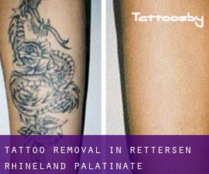 Tattoo Removal in Rettersen (Rhineland-Palatinate)