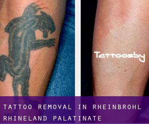 Tattoo Removal in Rheinbrohl (Rhineland-Palatinate)