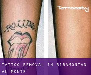 Tattoo Removal in Ribamontán al Monte