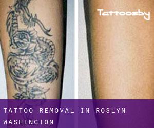 Tattoo Removal in Roslyn (Washington)