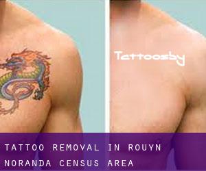 Tattoo Removal in Rouyn-Noranda (census area)