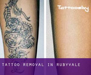 Tattoo Removal in Rubyvale