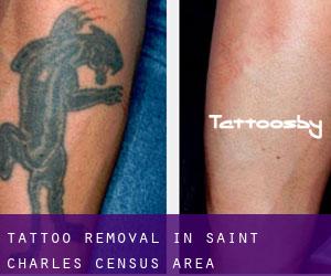 Tattoo Removal in Saint-Charles (census area)