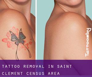 Tattoo Removal in Saint-Clément (census area)