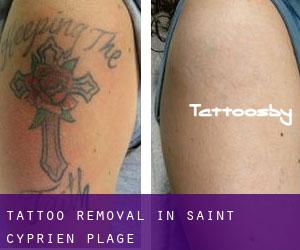 Tattoo Removal in Saint-Cyprien-Plage
