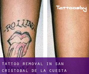 Tattoo Removal in San Cristóbal de la Cuesta