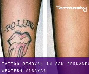 Tattoo Removal in San Fernando (Western Visayas)