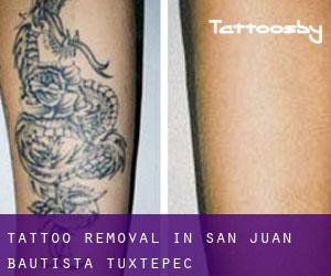 Tattoo Removal in San Juan Bautista Tuxtepec