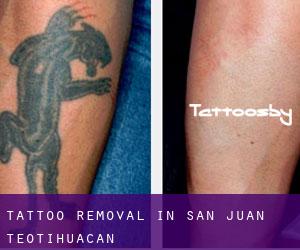 Tattoo Removal in San Juan Teotihuacán