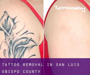 Tattoo Removal in San Luis Obispo County