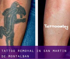 Tattoo Removal in San Martín de Montalbán