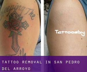 Tattoo Removal in San Pedro del Arroyo