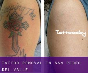 Tattoo Removal in San Pedro del Valle