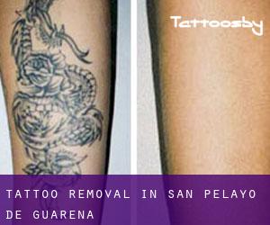 Tattoo Removal in San Pelayo de Guareña