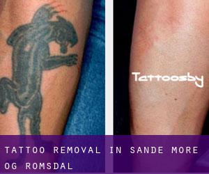 Tattoo Removal in Sande (Møre og Romsdal)