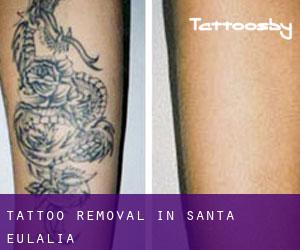 Tattoo Removal in Santa Eulalia