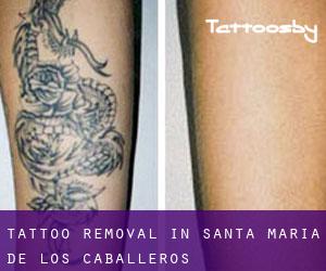 Tattoo Removal in Santa María de los Caballeros