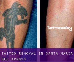 Tattoo Removal in Santa María del Arroyo