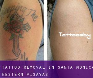 Tattoo Removal in Santa Monica (Western Visayas)