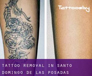 Tattoo Removal in Santo Domingo de las Posadas