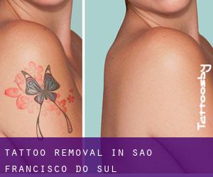 Tattoo Removal in São Francisco do Sul