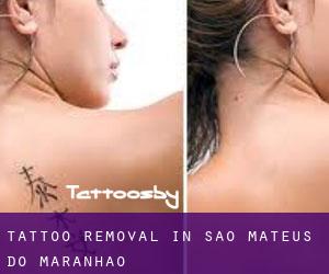 Tattoo Removal in São Mateus do Maranhão