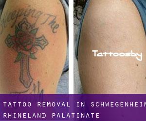 Tattoo Removal in Schwegenheim (Rhineland-Palatinate)