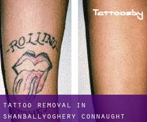 Tattoo Removal in Shanballyoghery (Connaught)