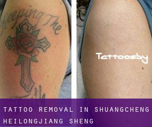 Tattoo Removal in Shuangcheng (Heilongjiang Sheng)