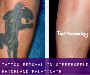 Tattoo Removal in Sippersfeld (Rhineland-Palatinate)