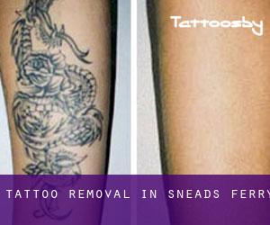 Tattoo Removal in Sneads Ferry