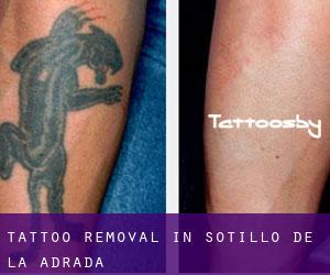 Tattoo Removal in Sotillo de la Adrada