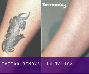 Tattoo Removal in Táliga