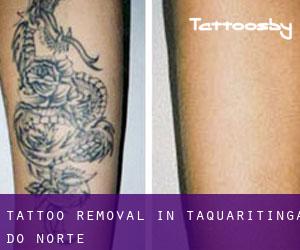 Tattoo Removal in Taquaritinga do Norte