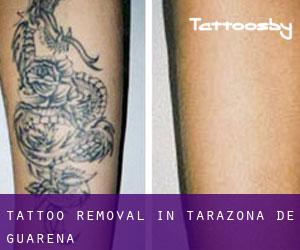 Tattoo Removal in Tarazona de Guareña