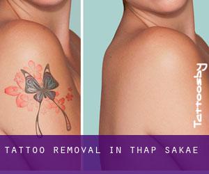 Tattoo Removal in Thap Sakae