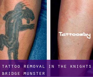 Tattoo Removal in The Knight's Bridge (Munster)