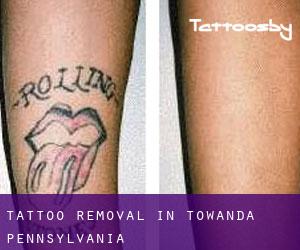 Tattoo Removal in Towanda (Pennsylvania)