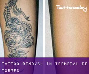 Tattoo Removal in Tremedal de Tormes