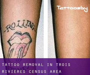 Tattoo Removal in Trois-Rivières (census area)