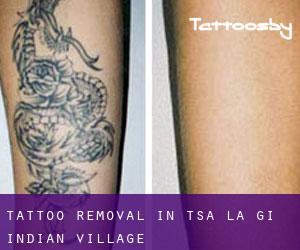 Tattoo Removal in Tsa La Gi Indian Village