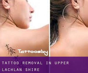 Tattoo Removal in Upper Lachlan Shire