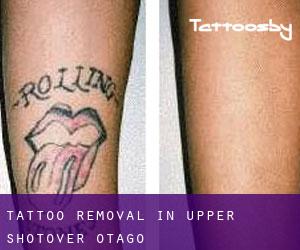 Tattoo Removal in Upper Shotover (Otago)