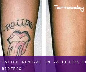 Tattoo Removal in Vallejera de Riofrío