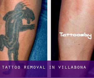 Tattoo Removal in Villabona