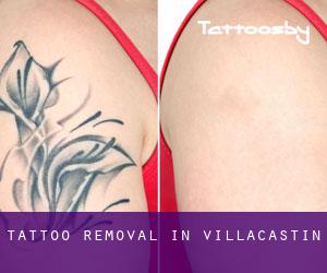 Tattoo Removal in Villacastín
