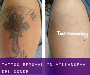 Tattoo Removal in Villanueva del Conde