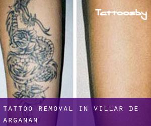 Tattoo Removal in Villar de Argañán