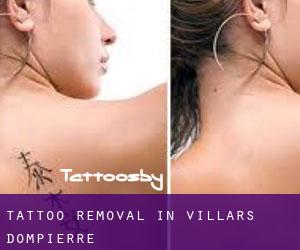 Tattoo Removal in Villars-Dompierre