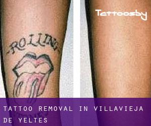 Tattoo Removal in Villavieja de Yeltes